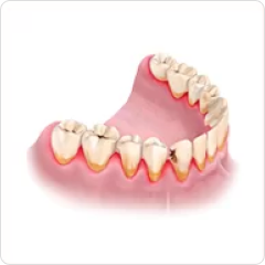 Тяжелая форма пародонтоза (выпадают зубы)